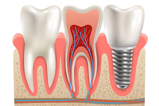 permanent false teeth