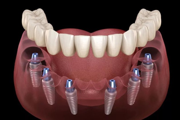 full mouth dental implants near me