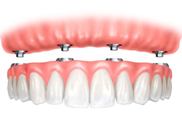 full mouth dental implants for seniors