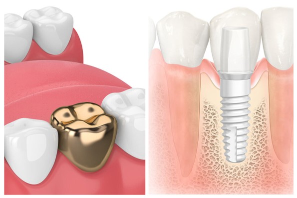 zirconia implants gold teeth dentist near me