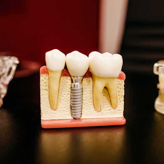 tooth implant
